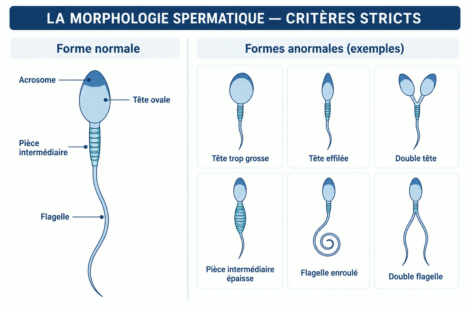 Planche de morphologie spermatique selon les critères stricts : un spermatozoïde de forme normale avec acrosome, tête ovale, pièce intermédiaire et flagelle, face à six exemples d'anomalies (tête trop grosse, tête effilée, double tête, pièce intermédiaire épaisse, flagelle enroulé, double flagelle).