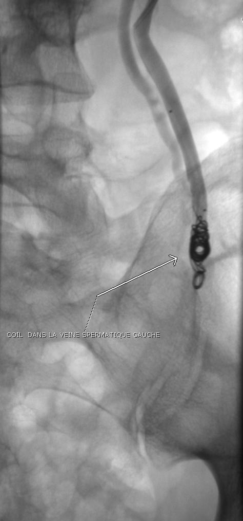 Phlébographie de la veine spermatique gauche montrant un spiral d'embolisation (coil) radio-opaque positionné dans la veine, après opacification par produit de contraste.